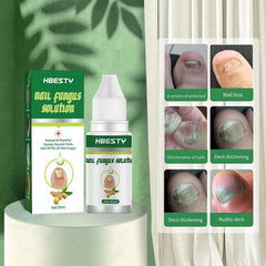 Nail Fungal Treatment Feet Care Nail Foot Toe Nail Fungus Removal Gel Anti Infection Paronychia Onychomycosis